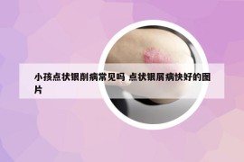 小孩点状银削病常见吗 点状银屑病快好的图片