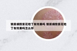 银屑病擦紫花地丁有效果吗 银屑病擦紫花地丁有效果吗怎么样