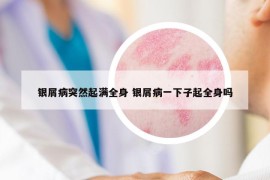 银屑病突然起满全身 银屑病一下子起全身吗