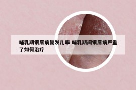 哺乳期银屑病复发几率 哺乳期间银屑病严重了如何治疗