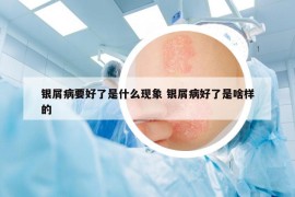 银屑病要好了是什么现象 银屑病好了是啥样的