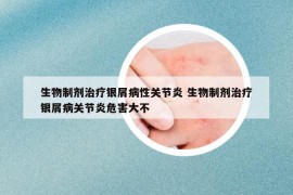 生物制剂治疗银屑病性关节炎 生物制剂治疗银屑病关节炎危害大不