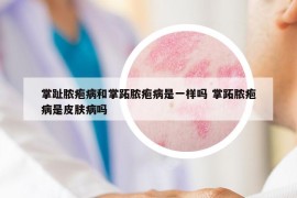 掌趾脓疱病和掌跖脓疱病是一样吗 掌跖脓疱病是皮肤病吗