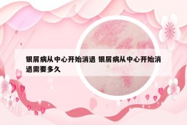 银屑病从中心开始消退 银屑病从中心开始消退需要多久