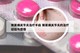 银屑病关节炎治疗手段 银屑病关节炎的治疗经验与感悟