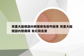 阴囊大腿根部内侧瘙痒有藓咋回事 阴囊大腿根部内侧瘙痒 有红斑皮屑