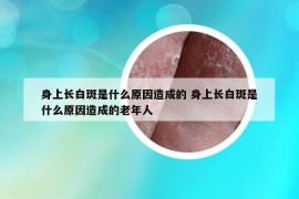 身上长白斑是什么原因造成的 身上长白斑是什么原因造成的老年人