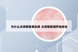 为什么点滴银屑病会痒 点滴银屑病开始掉皮