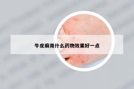 牛皮癣用什么药物效果好一点