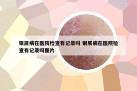 银屑病在医院检查有记录吗 银屑病在医院检查有记录吗图片