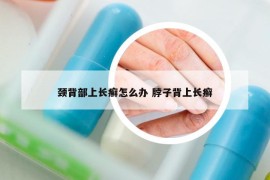 颈背部上长癣怎么办 脖子背上长癣