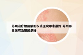 苏州治疗银屑病的权威医院哪家最好 苏州哪里医院治银屑病好