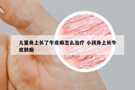 儿童身上长了牛皮癣怎么治疗 小孩身上长牛皮肤癣