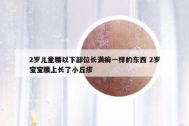 2岁儿童腰以下部位长满癣一样的东西 2岁宝宝腰上长了小丘疹