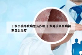 十岁小孩牛皮癣怎么办啊 十岁男孩银屑病初期怎么治疗