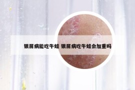 银屑病能吃牛蛙 银屑病吃牛蛙会加重吗