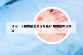 请问一下银屑病怎么治疗最好 银屑病如何根冶