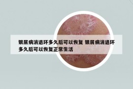 银屑病消退环多久后可以恢复 银屑病消退环多久后可以恢复正常生活