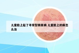 儿童脸上起了寻常型银屑病 儿童脸上的癣怎么治