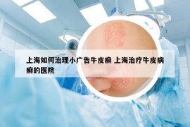 上海如何治理小广告牛皮癣 上海治疗牛皮病癣的医院