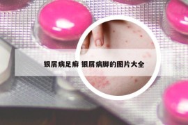 银屑病足癣 银屑病脚的图片大全