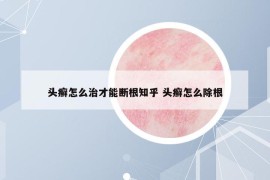 头癣怎么治才能断根知乎 头癣怎么除根