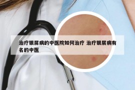 治疗银屑病的中医院如何治疗 治疗银屑病有名的中医