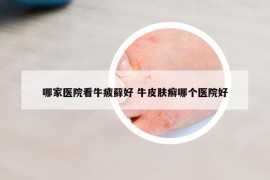 哪家医院看牛疲藓好 牛皮肤癣哪个医院好