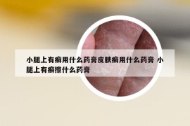 小腿上有癣用什么药膏皮肤癣用什么药膏 小腿上有癣擦什么药膏