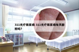 311光疗银屑病 311光疗银屑病每天都照吗?