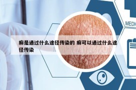 癣是通过什么途径传染的 癣可以通过什么途径传染