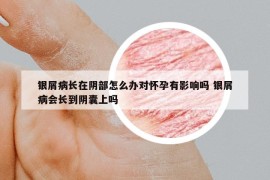 银屑病长在阴部怎么办对怀孕有影响吗 银屑病会长到阴囊上吗