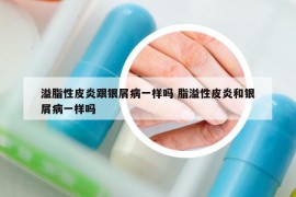 溢脂性皮炎跟银屑病一样吗 脂溢性皮炎和银屑病一样吗