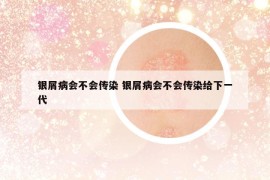 银屑病会不会传染 银屑病会不会传染给下一代