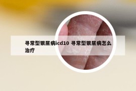 寻常型银屑病icd10 寻常型银屑病怎么治疗