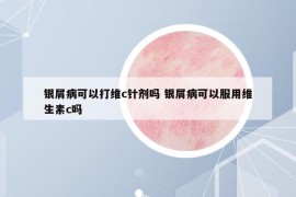 银屑病可以打维c针剂吗 银屑病可以服用维生素c吗