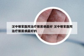 汉中哪家医院治疗银屑病最好 汉中哪家医院治疗银屑病最好的