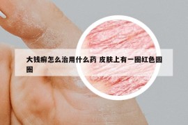 大钱癣怎么治用什么药 皮肤上有一圈红色圆圈