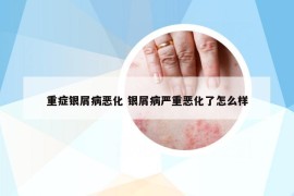 重症银屑病恶化 银屑病严重恶化了怎么样