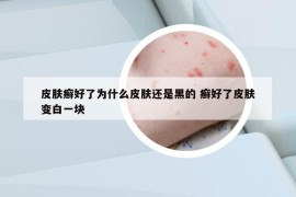 皮肤癣好了为什么皮肤还是黑的 癣好了皮肤变白一块