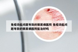 免疫功能问题导致的银屑病医院 免疫功能问题导致的银屑病医院能治好吗