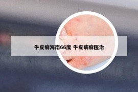 牛皮癣海南66度 牛皮病癣医治