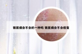 银屑病会不会的一种吗 银屑病会不会癌变