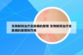 生物制剂治疗皮肤病的原理 生物制剂治疗皮肤病的原理和作用