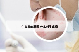 牛皮廨的原因 什么叫牛皮廨