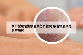 关节型脓包型银屑病怎么住院 脓泡银屑又是关节银屑