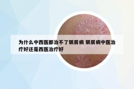 为什么中西医都治不了银屑病 银屑病中医治疗好还是西医治疗好