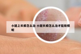 小腿上长癣怎么治 小腿长癣怎么治才能除根呢