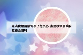 点滴状银屑病怀孕了怎么办 点滴状银屑病自愈还会犯吗