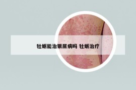 牡蛎能治银屑病吗 牡蛎治疗